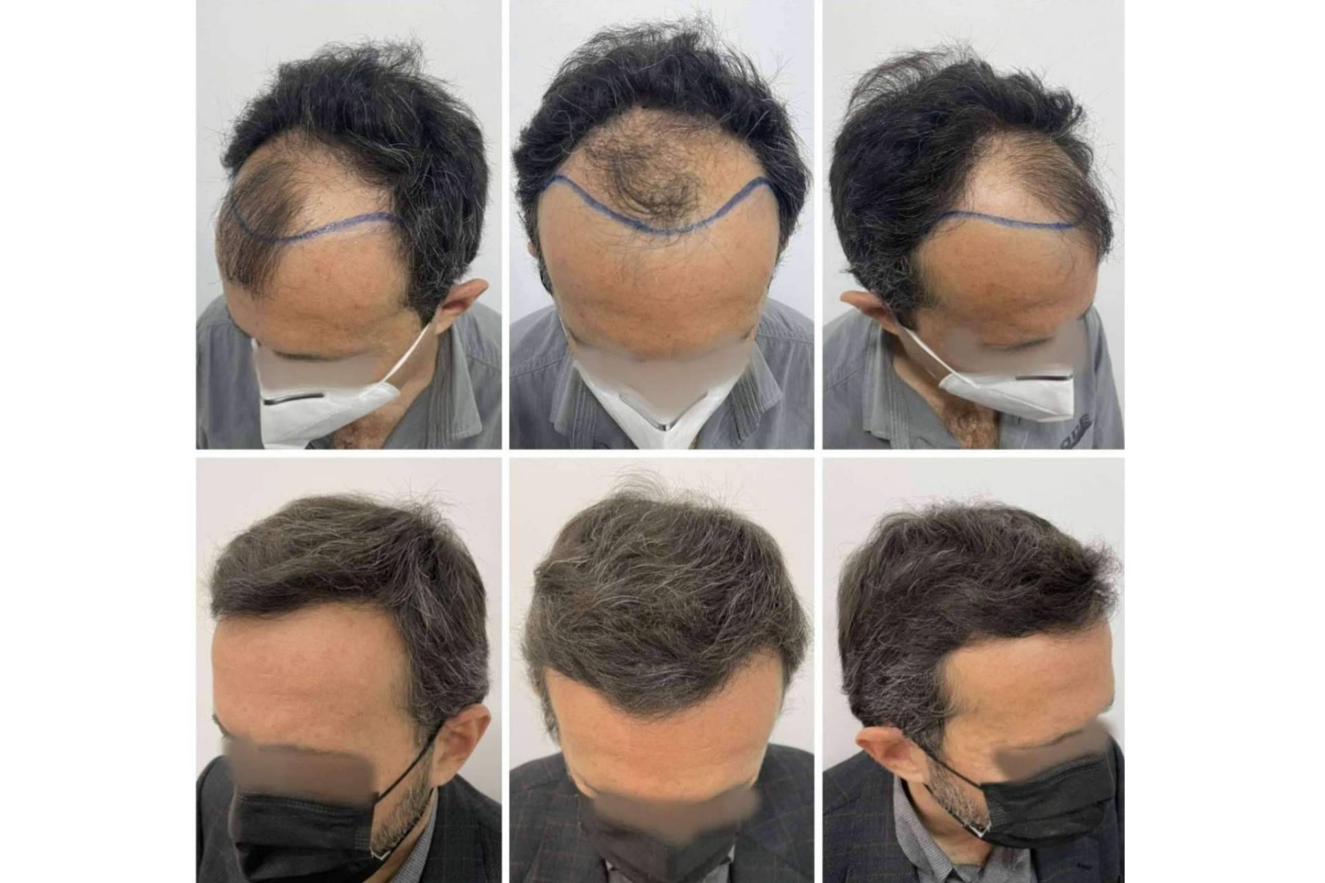 Dr. Bruno Jacobovski, ¿En qué consiste el PRP capilar y qué cuidados se han de seguir tras el tratamiento?